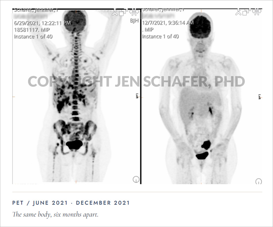 Jen Schafer PET Scan, watermarked, showing before and after.
